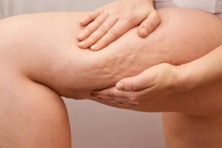 ¿Cómo eliminar la celulitis?